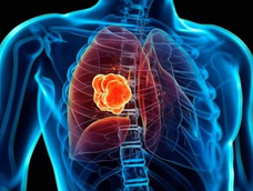 que es un nodulo pulmonar: la afeccion por la que sera operado el papa leon xiv que es un nodulo pulmonar: la afeccion por la que sera operado el papa leon xiv