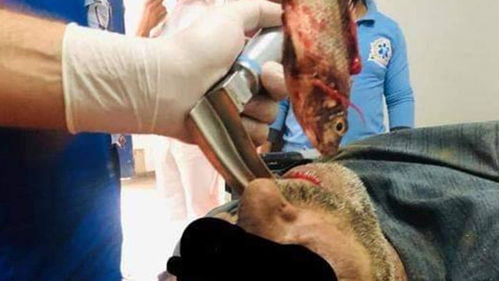 Le sacaron un pez vivo de la garganta a un pescador