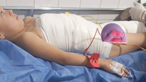 A un nene se le cayó encima una tetera con agua hirviendo y sufrió quemaduras en el 50% de su cuerpo