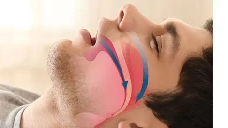 LA APNEA DEL SUEÑO se debe tanto a factores fisiológicos como a hábitos de vida. Entre los primeros se destacan las obstrucciones en las vías respiratorias, alteraciones anatómicas o condiciones médicas específicas.