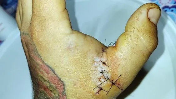 Un padre atacó con un cuchillo al hombre que tatuó a su hija menor sin su consentimiento