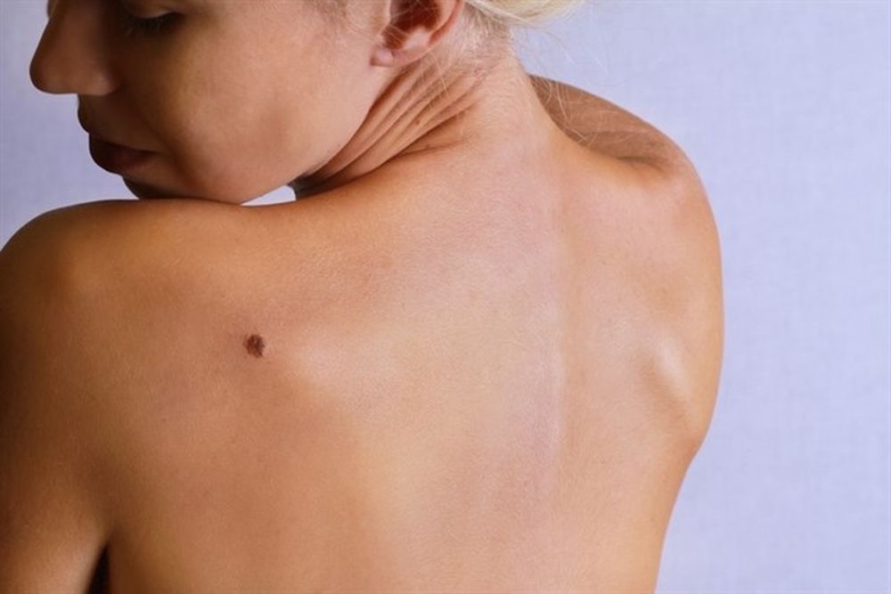 Conocé el significado de tus lunares según su ubicación en el cuerpo