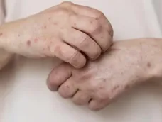 Sarampión.- Sarampión.-