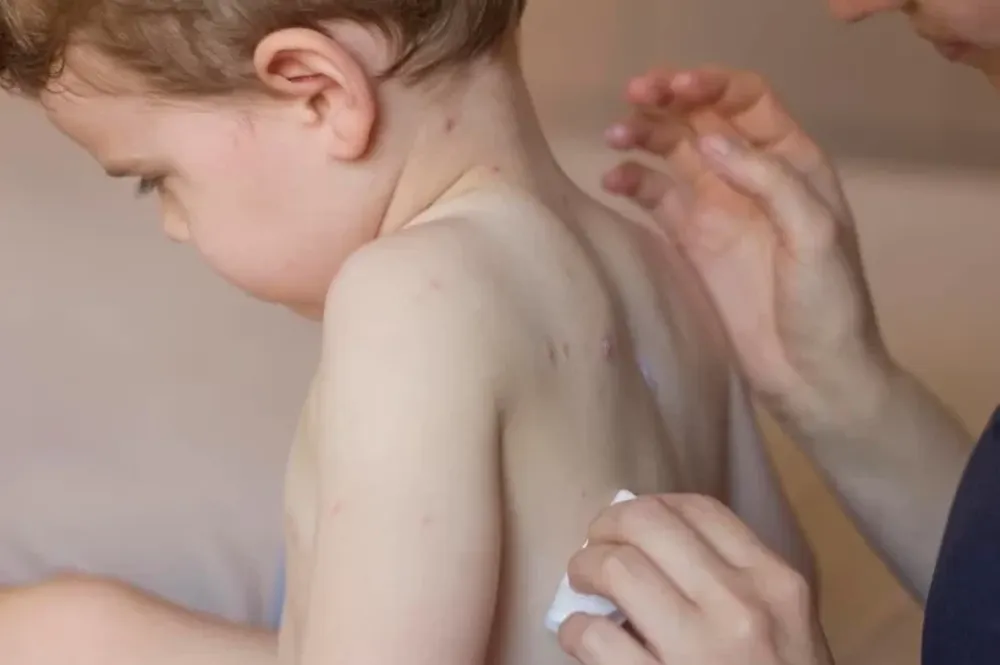 Una nena de 2 años, el primer caso de sarampión en el país después de 6 años