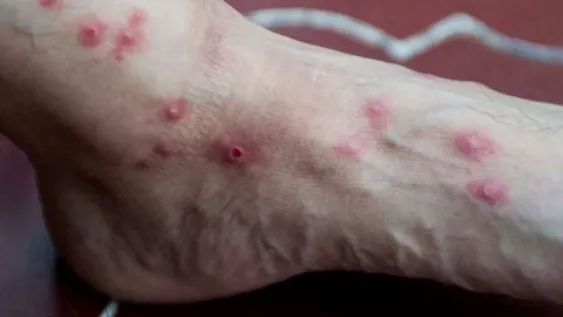 Confirmaron el primer caso de viruela del mono en San Juan