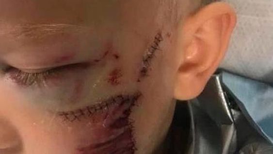 Un bebé fue atacado por su propio perro y sufrió una grave herida en el rostro