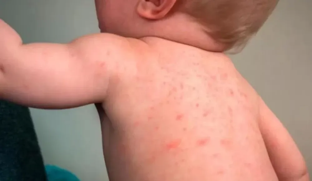 Alerta epidemiológica por nuevos casos de sarampión en Argentina