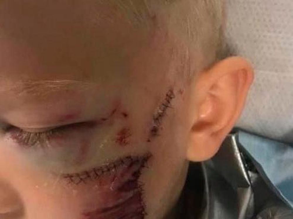 Un bebé fue atacado por su propio perro y sufrió una grave herida en el rostro