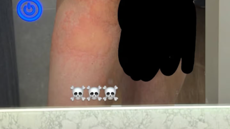 Martín Cirio sufrió un brote en la piel y se sacó fotos impactantes