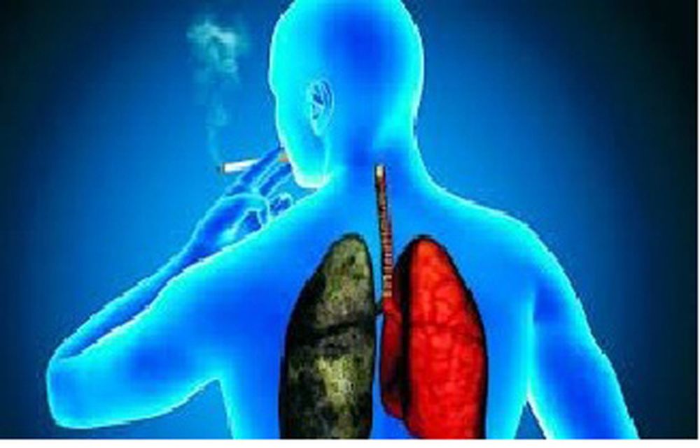 Detección temprana del cáncer de pulmón