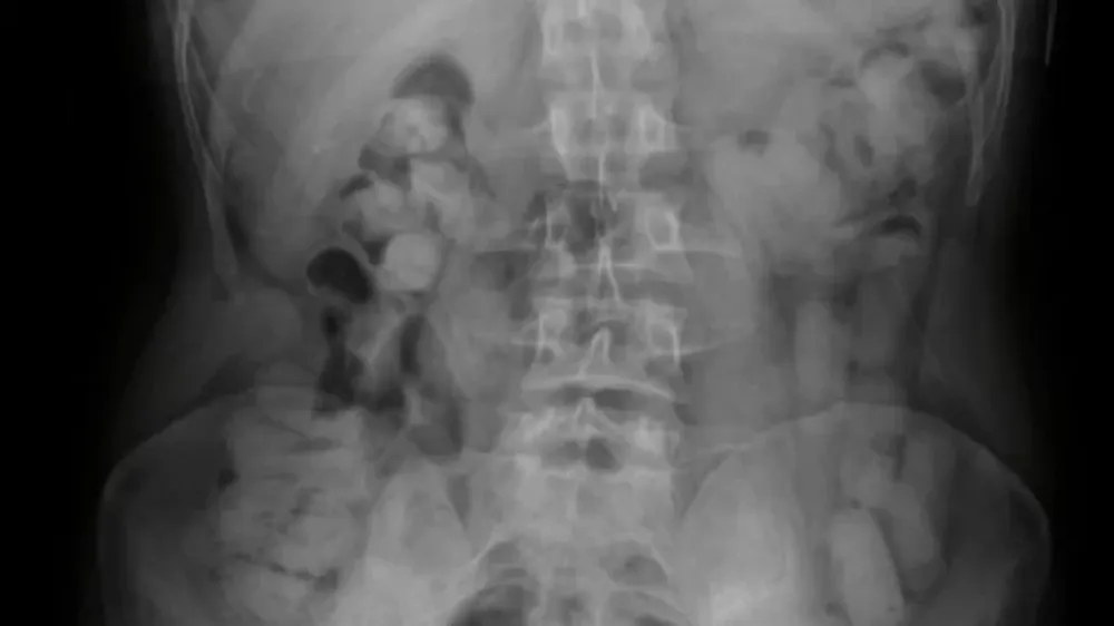 Insólito: por lo que llevaban en sus estómagos, caen tres bolivianos que viajaban a San Juan