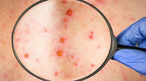 Chile declaró la alerta sanitaria por la viruela del mono