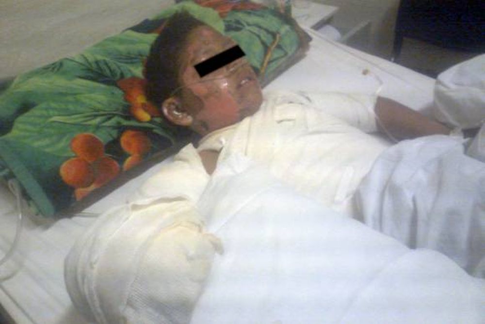 Dos niños con quemaduras graves por jugar con fuego