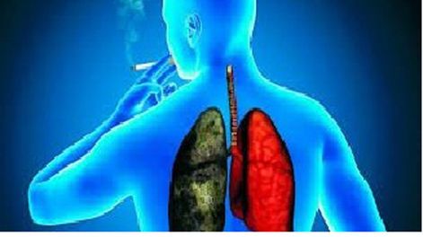 Detección temprana del cáncer de pulmón