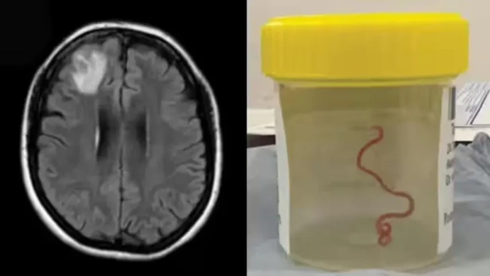 Una mujer sometida a una cirugía y le extrajeron del cerebro a una criatura viva