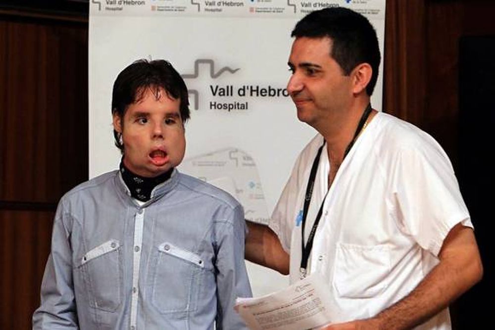 La nueva cara del primer trasplantado