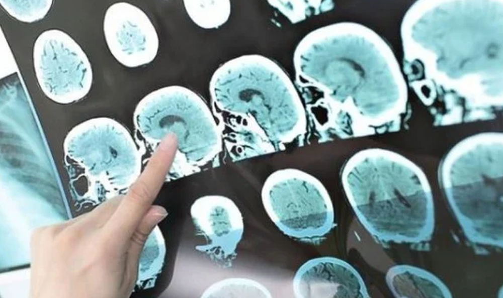 Destacan los resultados de un fármaco contra el Alzheimer, pero advierten sobre efectos secundarios