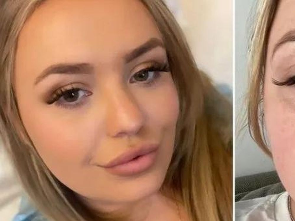 Quiso aumentar el tamaño de sus labios, pero quedó desfigurada