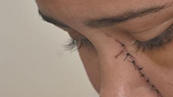 Su ex la atacó: le dieron puntos en el cuello, la nariz, el mentón, el abdomen y el labio