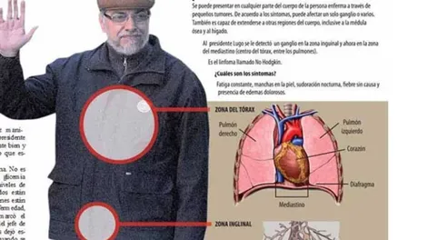 Paraguay: Lugo está más grave y habló su posible sucesor