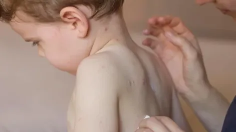 Una nena de 2 años, el primer caso de sarampión en el país después de 6 años