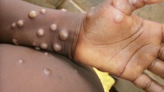 Hay más de 1.000 casos de viruela del mono y temen que se instale en países no endémicos