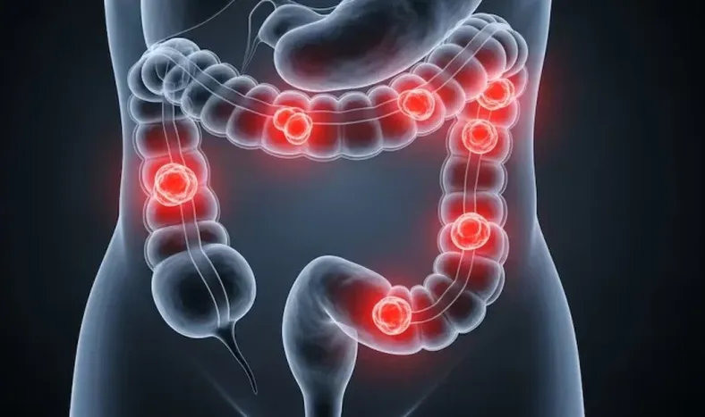 Científicos argentinos desarrollaron un virus que ataca el cáncer colorrectal y sus células resistentes