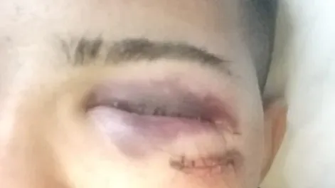 Hoy realizarán un examen en la zona del ojo al menor, para saber si la fractura pudo acarrear otras complicaciones.