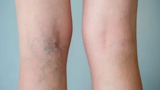 Una de cada 4 muertes es de trombosis