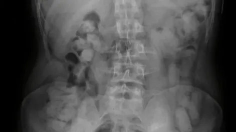 Insólito: por lo que llevaban en sus estómagos, caen tres bolivianos que viajaban a San Juan