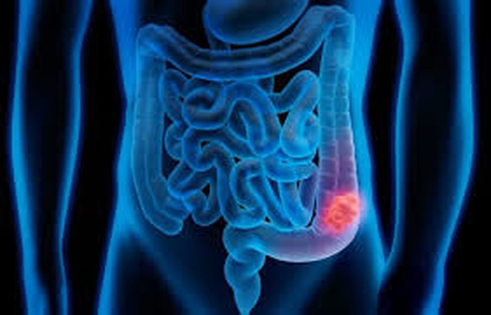 Cada día se suman más de 40 casos de cáncer de colon