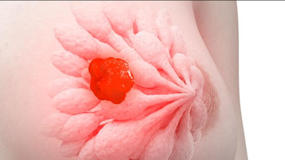 Cáncer de mama: descubren en qué momento se produce la metástasis