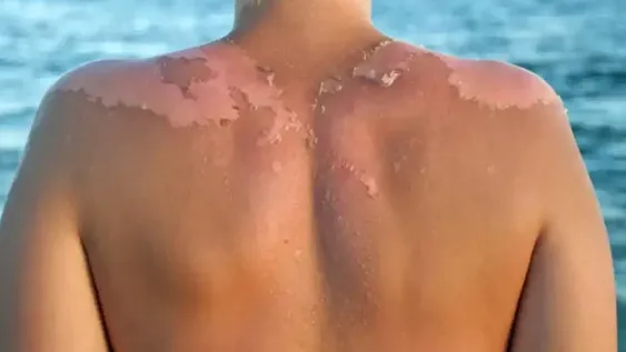 Las cuatro claves para evitar que la piel se pele al tomar Sol