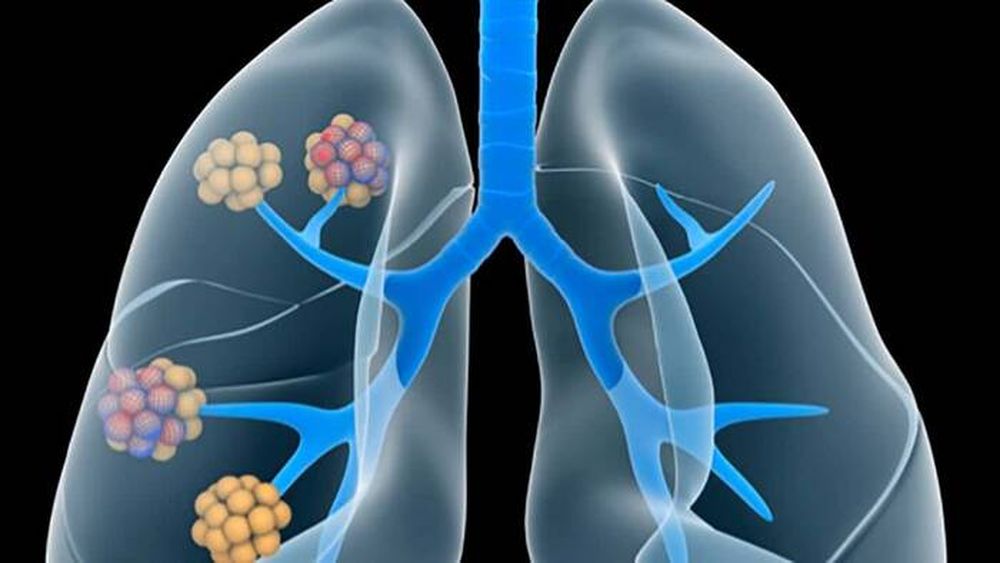 Hipertensión pulmonar: se considera dentro de las 7.000 enfermedades raras en el mundo