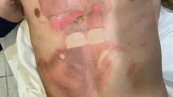 Juan Ignacio Castro Cerdera sufrió lesiones graves tras ser quemado con agua hervida. Según su madre quedó con un profundo daño psicológico.