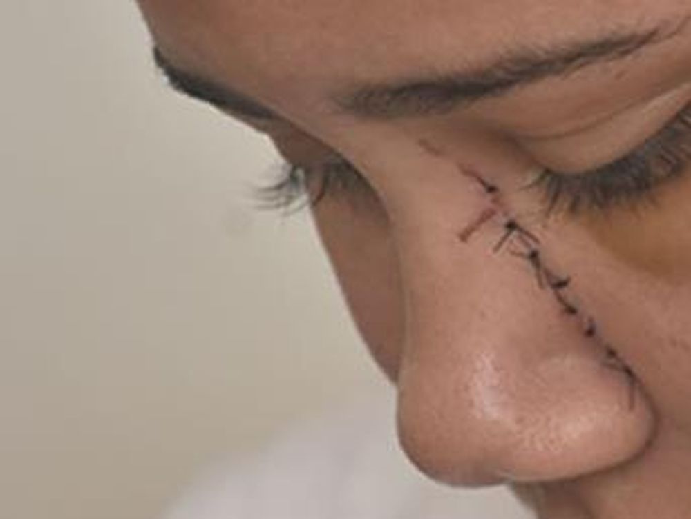 Su ex la atacó: le dieron puntos en el cuello, la nariz, el mentón, el abdomen y el labio