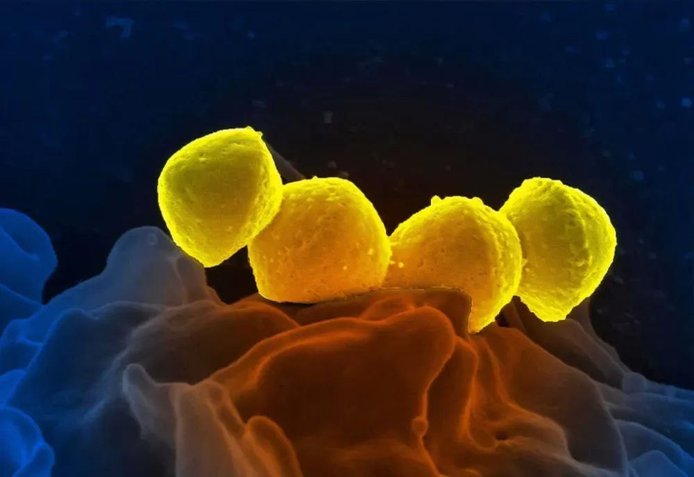 La situación epidemiológica de Streptococcus Pyogenes en el país: 78 muertes