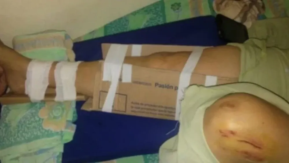 Le inmovilizaron la pierna con cartón porque no había yeso