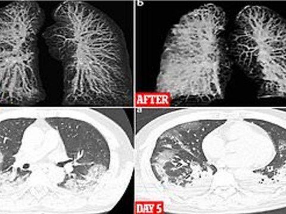 Crudas imágenes muestran el daño pulmonar que puede causar el coronavirus