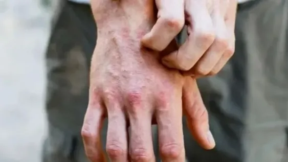 De qué se trata el síndrome de “dedos congelados”, nuevo síntoma del coronavirus