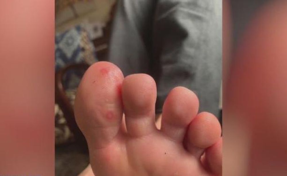 “Dedos Covid”: el nuevo síntoma que inquieta a los científicos