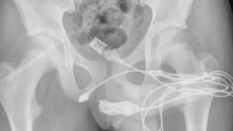 Un chico intentaba medir su pene y se le enredó un cable USB en la uretra