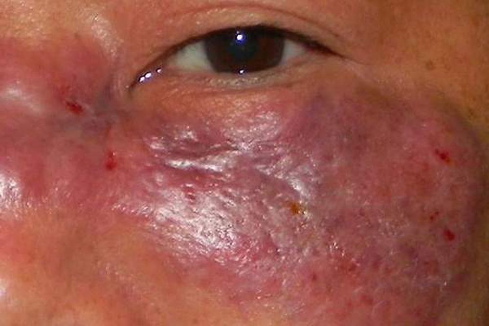 Alerta por caso de “hongo negro” que registró Formosa