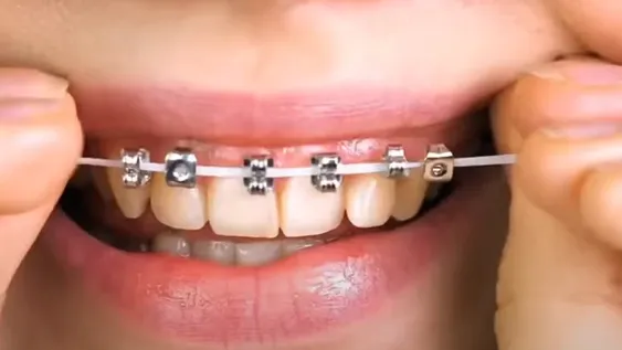 Odontólogos piden que los jóvenes no se sumen a la moda de los brackets falsos
