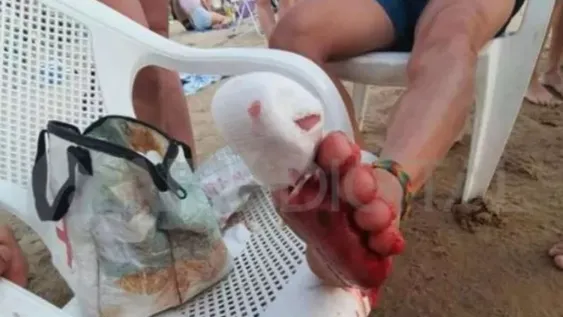 Impresionante ataque de palometas: hubo 30 heridos y una adolescente perdió un dedo