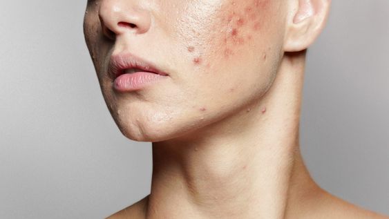 una afeccion en menopausia: el acne en mujeres adultas