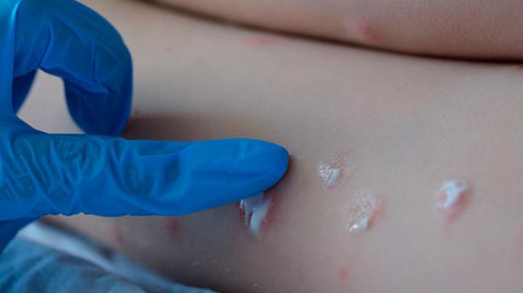 La OMS deja de distinguir países endémicos y no endémicos en datos sobre viruela del mono