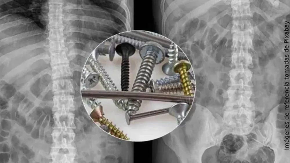 Médicos hallaron un kilo de clavos y tornillos en el estómago de paciente