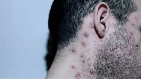 Estudio revela que 95% de casos de viruela del mono se transmite por actividad sexual