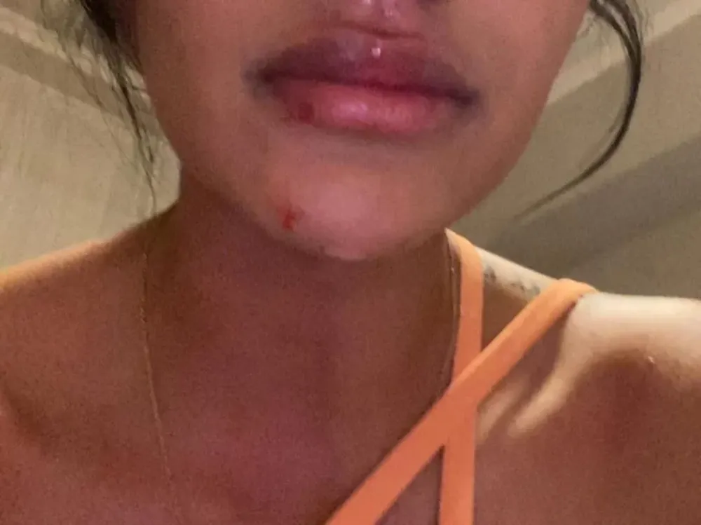 Denunció a su pareja porque la había agredido y el hombre se desquitó reventándole el labio